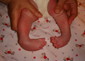 A baby with bilateral clubfoot deformity