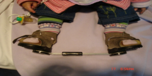 Denis Brown splint