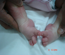 Before treatment