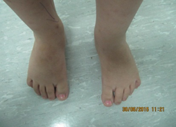 5 years follow up with residual adducted forefoot deformity