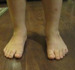 6 years follow up and after tibialis anterior tendon transfer